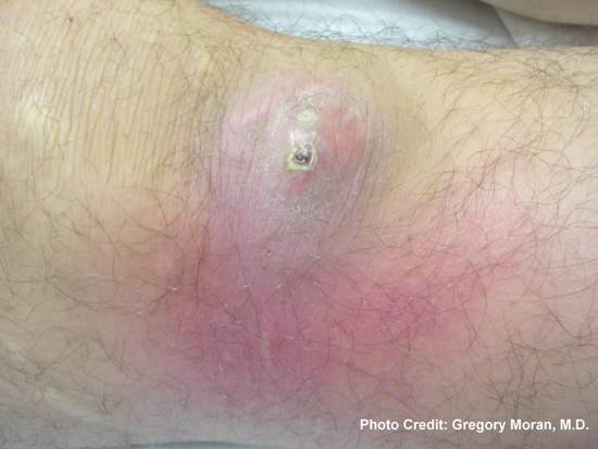 Photograph depicted a cutaneous abscess, which had been caused by methicillin-resistant Staphylococcus aureus bacteria, referred to by the acronym MRSA. Photo credit: Gregory Moran, M.D.