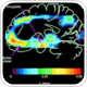 Study: Protein clumps in nerve cells are pathologies of Parkinson's disease