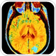 Clinical trial signals new era in treatment of neurodegererative disorders