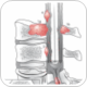 Patients with chronic constipation at increased risk of colorectal cancer, benign neoplasms