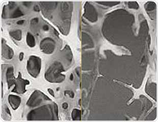 Osteoporosis