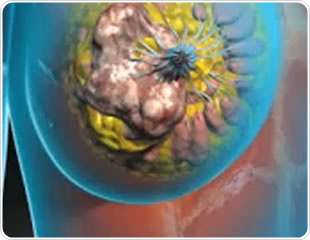 Mastectomy