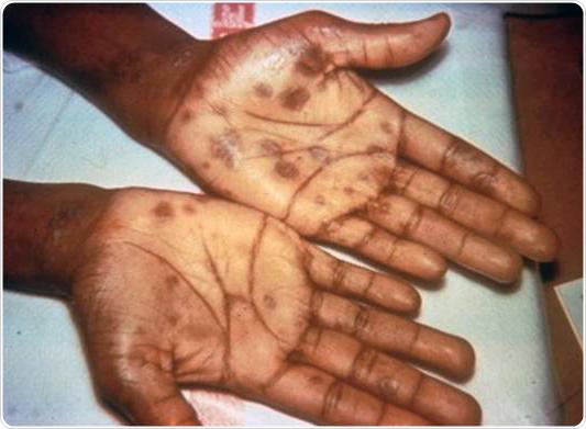 Secondary stage syphilis sores (lesions) on the palms of the hands. Referred to as 'palmar lesions.'