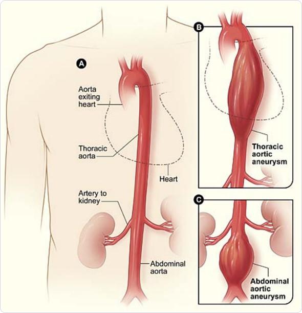 Dilatation Des Branches Pdf