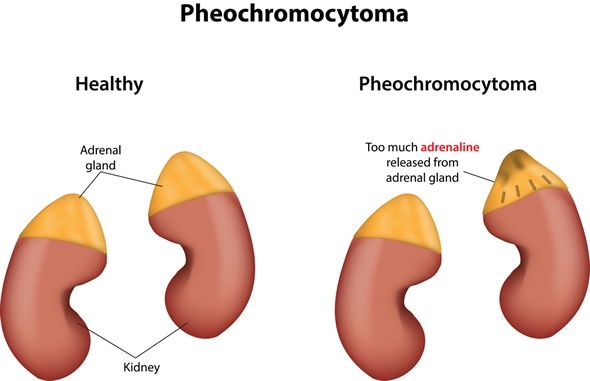 Image result for pheochromocytoma