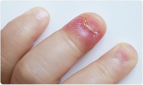 Redness of the nail bed caused by infection - wide 6