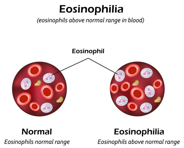 What Is Eosinophilia
