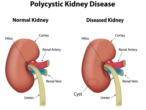What are the symptoms of bilateral renal cysts?