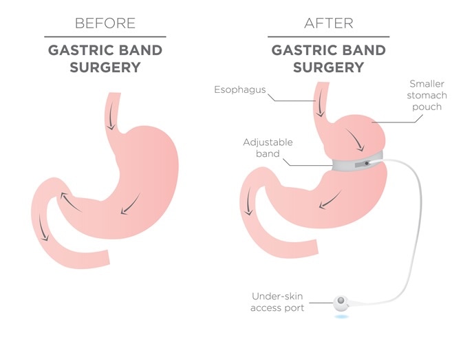 Weight Loss After Bariatric Surgery