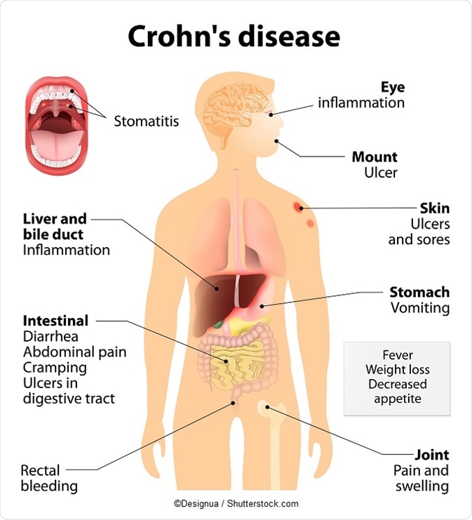 What are symptoms of Crohn's disease?
