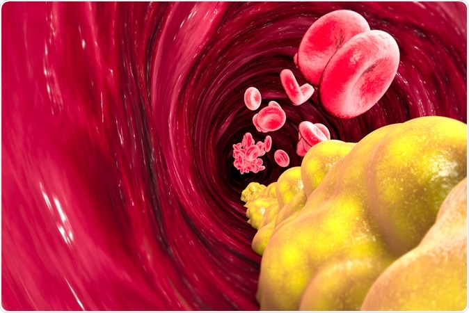   Formation of cholesterol, fat, artery, vein, heart. Narrowing of a vein for the formation of fat. 3d rendering. Image credit: Naeblys / Shutterstock 