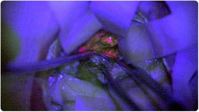 «Améliorer le diagnostic peropératoire des gliomes de haut grade à l'aide d'un biomarqueur de fluorescence - résultat de l'étude GALA-BIDD du NCRI britannique», Kathreena Kurian et al. M