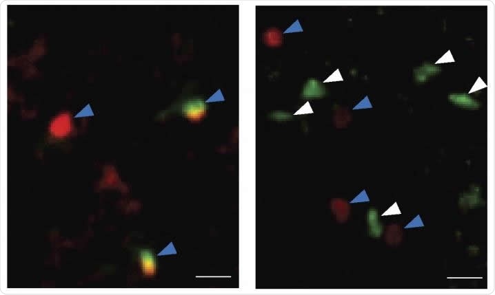 Health and Medical news: Staining for immune cells shows that the number of ILC2 cells (white arrows) are increased in the choroid plexus of old mice (right) compared with young mice (left). Other types of immune cells are indicated by blue arrows. Image Credit: Fung et al., 20200