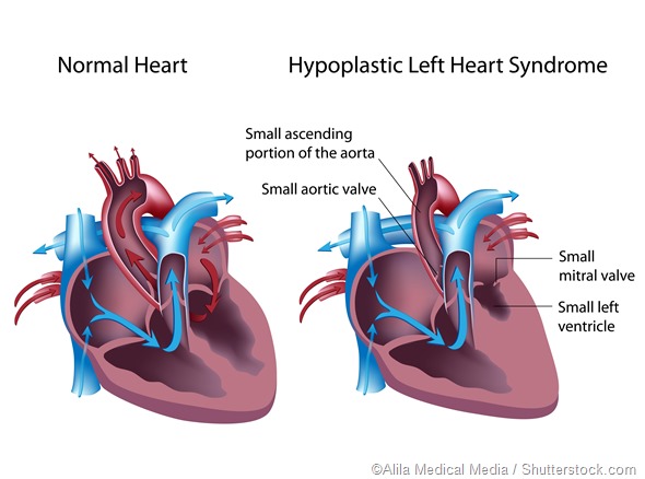 Causas Y Síntomas Del Síndrome Izquierdo Hipoplástico Del Corazón