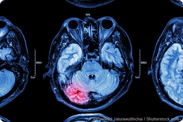 MRI brain injury