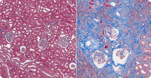 Normal Kidney (left) and Abnormal Kidney (renal failure) showing scarring (blue)