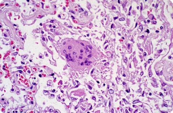 This photomicrograph reveals lung tissue pathology due to SARS. This photomicrograph reveals lung tissue pathology due to SARS.