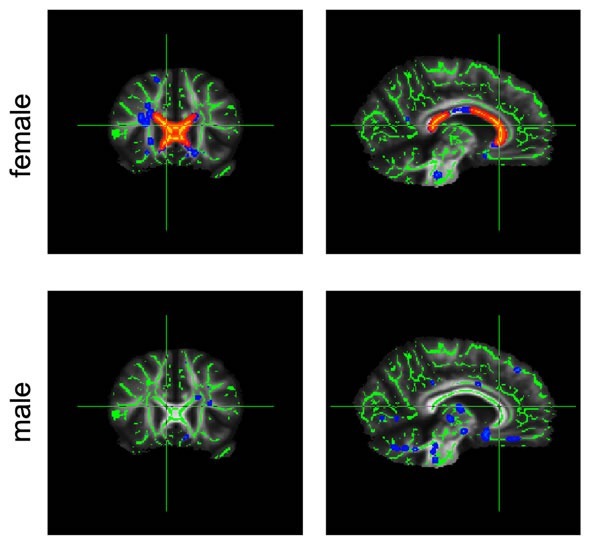 corpus callosum