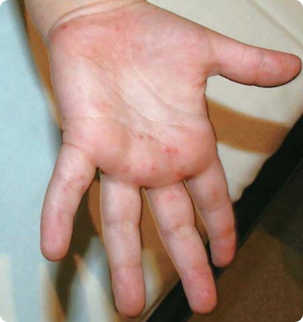 Hand Mouth And Foot Virus 96