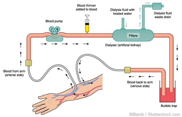 benefits-and-disadvantages-of-dialysis