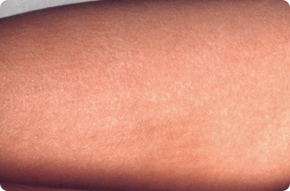 Scarlet Fever In Pregnant Women 80