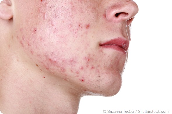 Acne Surgery