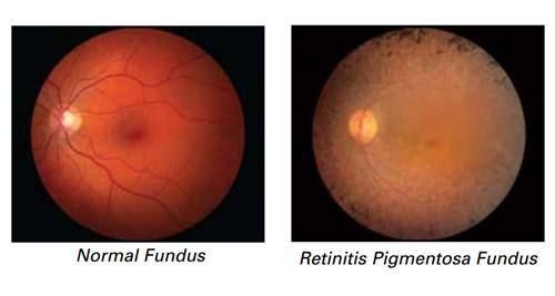 What Is Retinitis Pigmentosa 