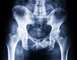 Women in high-deprivation areas face barriers to digital breast tomosynthesis screening