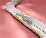 Dual lab tests accurately predict vein graft blood clots in patients during CABG