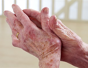 Pim1 identified as promising therapeutic target for inflammatory arthritis treatment
