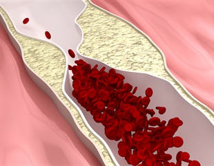 Specific intestinal fungi play role in the pathogenesis of MASLD and cardiovascular disease