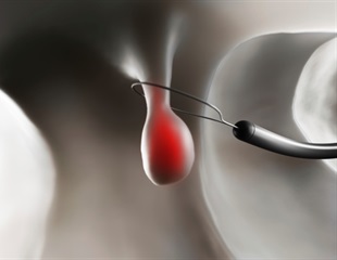 Laparoscopic-assisted colonoscopy with polypectomy reduces hospital utilization