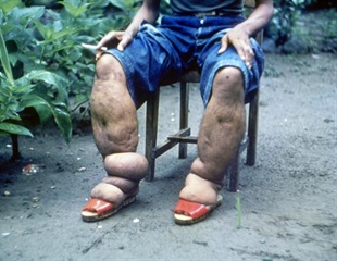 Anti-parasitic drug could accelerate the elimination of infection endemic to Africa