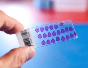 Pembrolizumab combination therapy improves survival in recurrent endometrial cancer patients