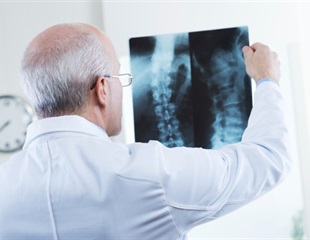 Young athletes commonly have bone marrow edema in lower spine, study shows