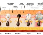 Acne and Make-Up