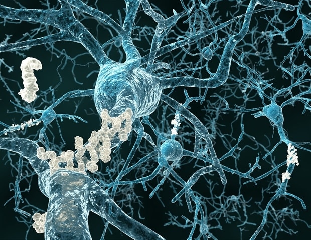 Photo of De nouveaux biomarqueurs pourraient aider à identifier les dommages synaptiques et la neurodégénérescence dans la maladie d’Alzheimer
