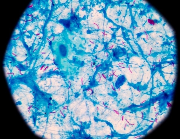 Bacterial infection tuberculosis