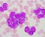 Advancements in molecular diagnostics for hematopoietic and lymphocytic neoplasms