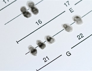 Study uncovers biological differences behind co-occurring conditions of Down syndrome