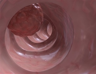 Targeting tumor-specific inflammatory process may prevent drug resistance in colon cancer