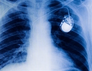 New battery-free pacemaker harvests power from every heartbeat