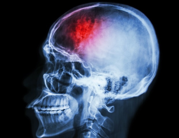 Cancer-fighting antibodies may trigger autoimmune brain disorders