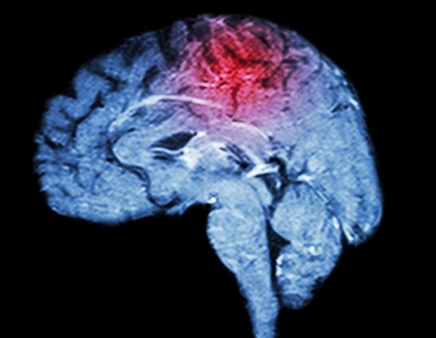 Cancer-fighting antibodies may trigger autoimmune brain disorders