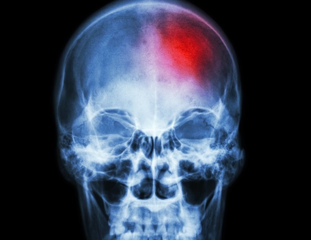 Cancer-fighting antibodies may trigger autoimmune brain disorders