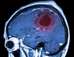 Experimental drug engasertib shows promise for treating inherited bleeding disorder