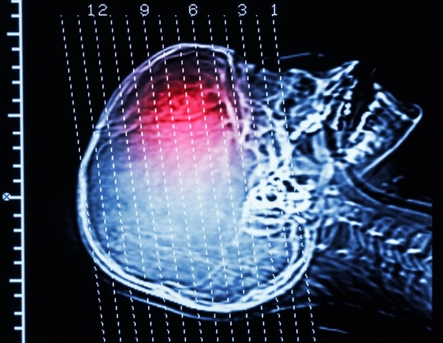 Genetic variant accelerates Huntington’s disease onset by over a decade