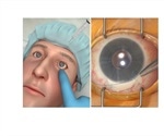 Touch Surgery announces release of 3D Trabeculectomy simulation