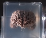 Being overweight associated with reduced white matter volume