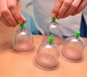 New noninvasive approach analyzes compounds released during cupping therapy